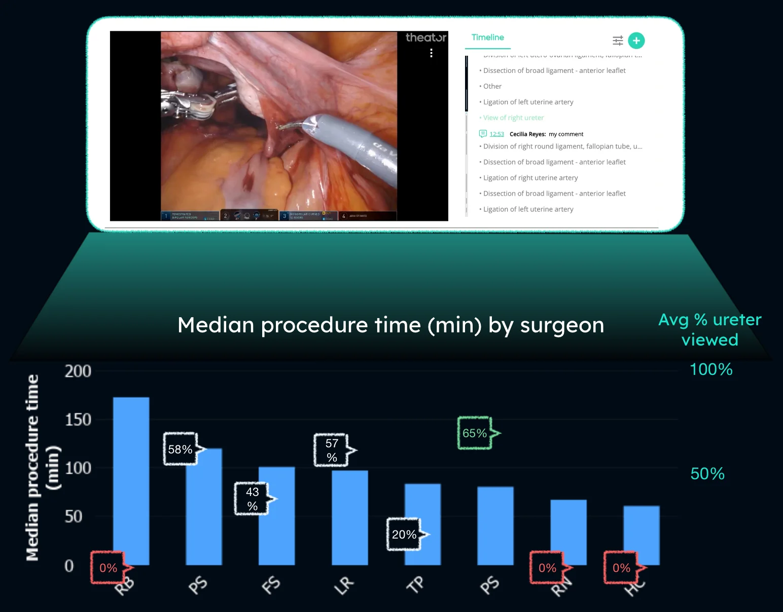 Screenshot from the Theator platform showing a timeline of surgery next to a still from a video of a procedure. Underneath the screenshot, a bar graph shows median procedure time in minutes by surgeon.