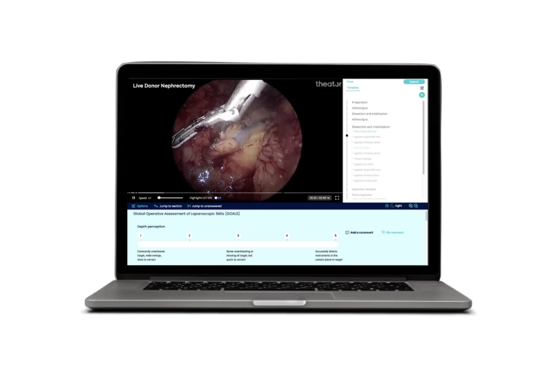 Theator platform open on a laptop showing a still from a live donor nephrectomy with timestamps of actions throughout the surgery.