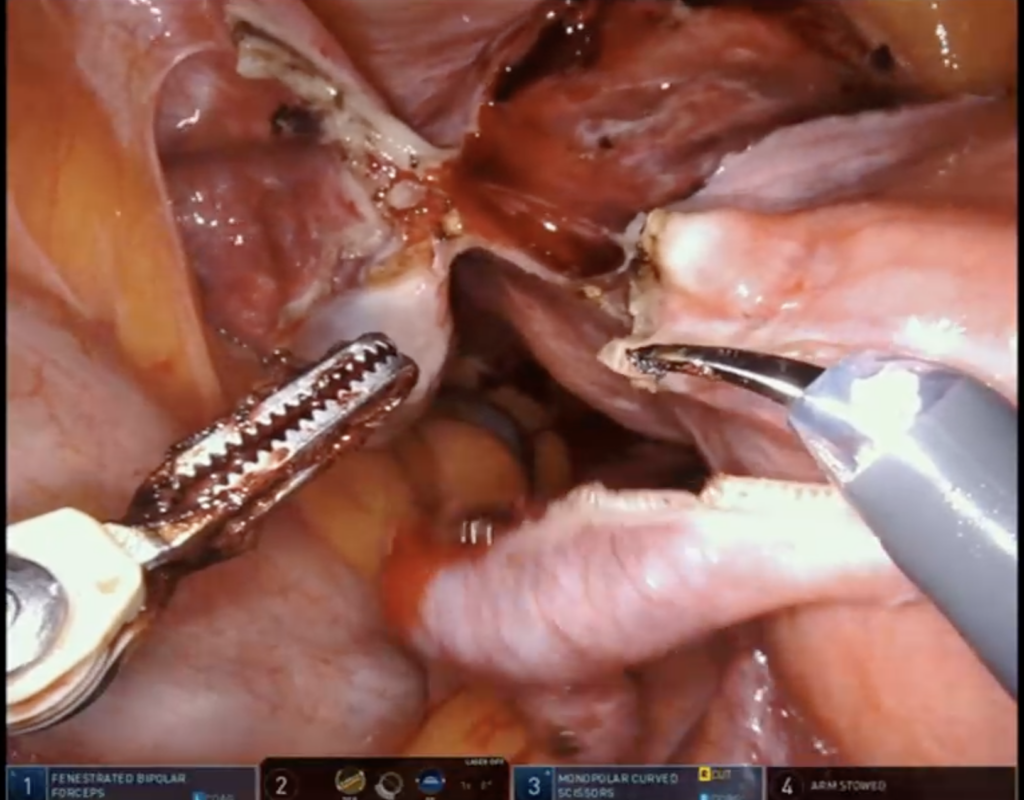 Surgical Spotlight: Laparoscopic Hysterectomy - Theator | The Surgical  Intelligence Company