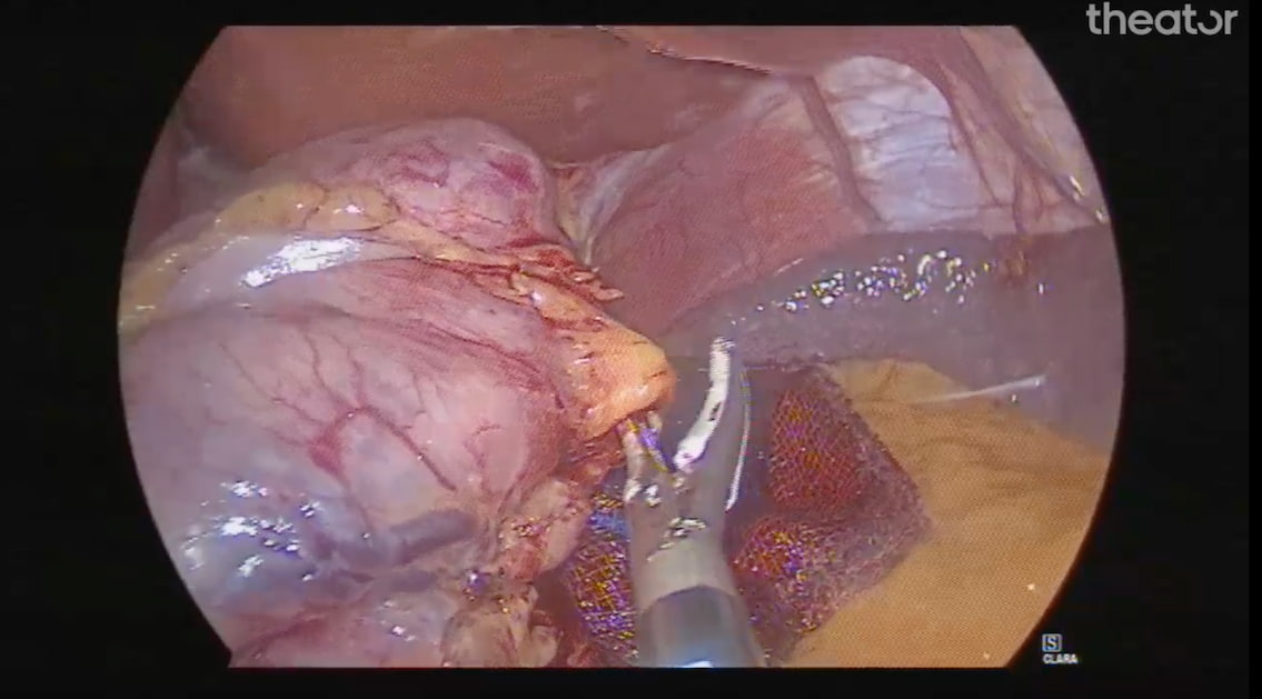 Dissection of greater curvature in sleeve gastrectomy